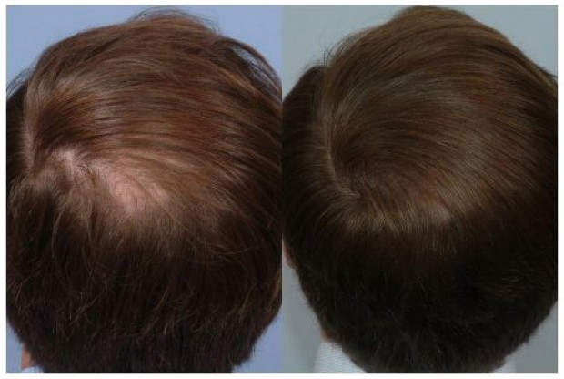 propecia before and after crown