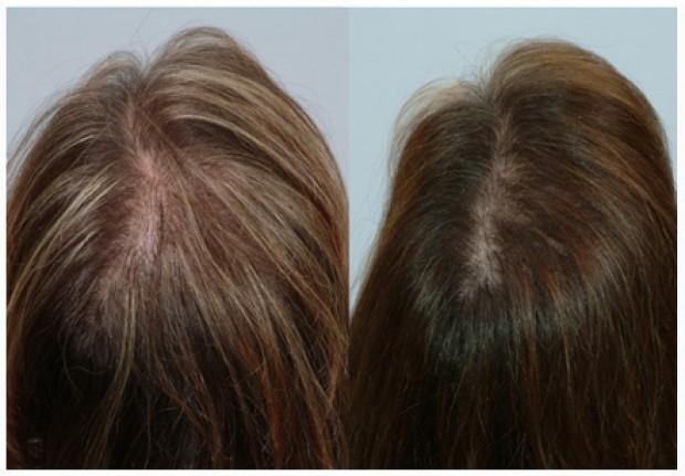 Hair loss in women | Understanding the symptoms & causes