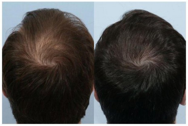 Images showing results of a hair transplant onto the crown