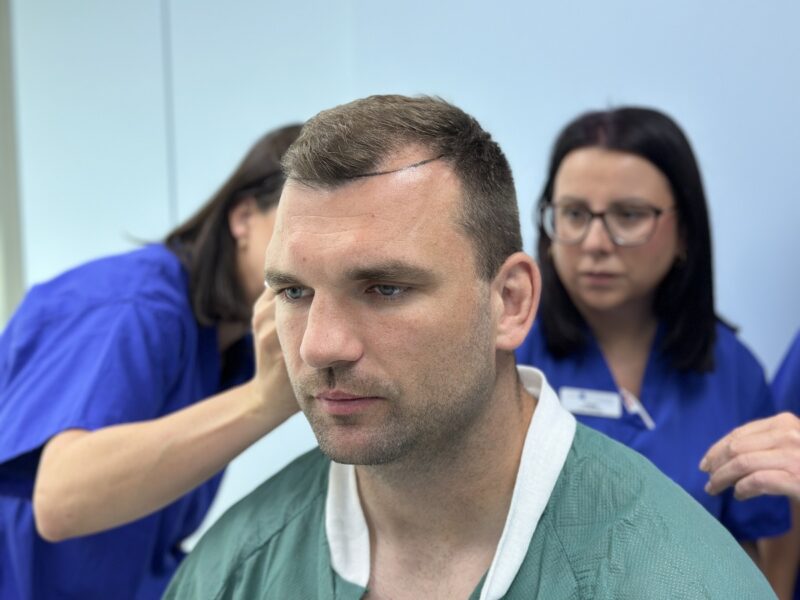 Tadhg Beirne hair transplant