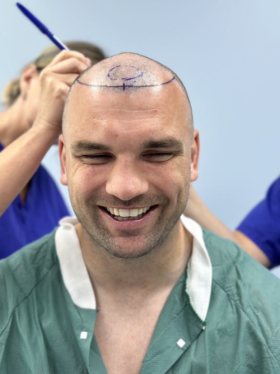 Tadhg Beirne hair transplant